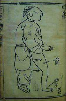 《针灸便用》