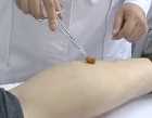 穴位注射操作示意图