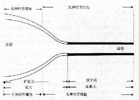 先天性巨结肠的发生示意图