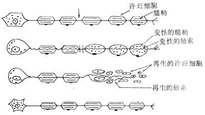 Waller变性模式图 (采自Escourolle)