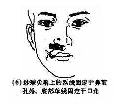 后鼻孔填塞法