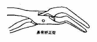 闭合性鼻骨骨折的复位器械