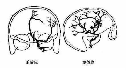 左额叶脑膜瘤
