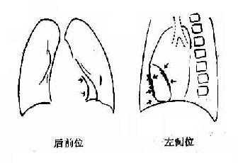 缩窄性心包炎