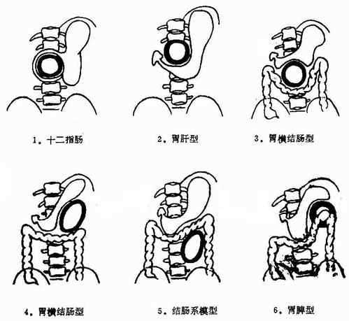 胰腺假性囊肿