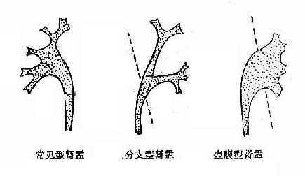 正常肾盂肾盏不同形状