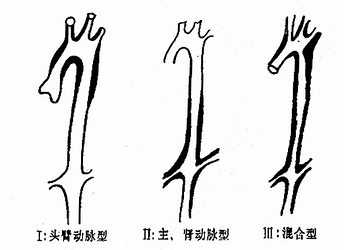 多发性大动脉炎分类示意图