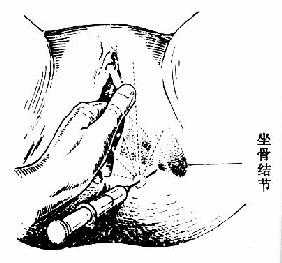 会阴浸润及阴部神经阻滞麻醉 以阻滞阴部神经示意图