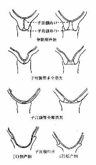 子宫颈管消失与子宫颈口扩张步骤