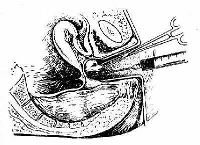 阴道后穹窿穿刺