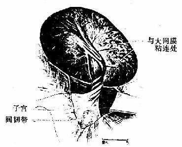 卵巢囊肺蒂扭转