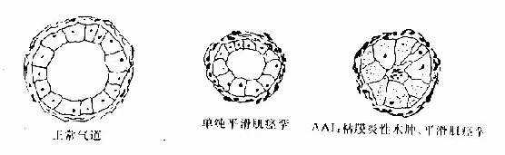 AAI及BHR引起的气道狭窄