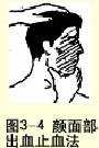 颜面部出血止血法