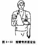  前臂骨折固定法