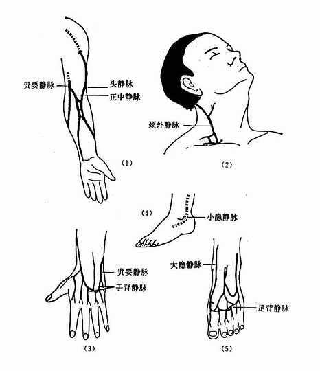 静脉注射部位
