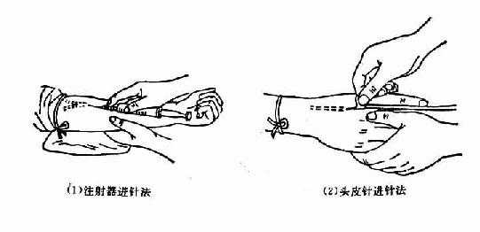 静脉注射操作方法