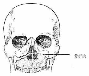 上颌骨骨折Ⅰ型