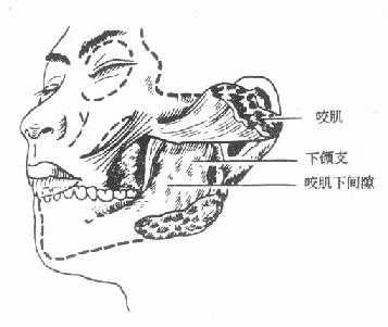 咬肌下蜂窝织发生的部位