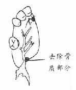 腭大孔后缘骨质已去除