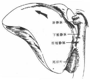 将肝脏向右翻转,逐根结扎肝短静脉