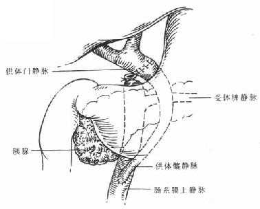 门静脉搭桥术