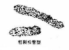 尿内各种管型