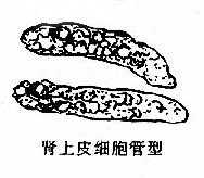 尿内各种管型