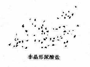 酸性尿内常见的结晶