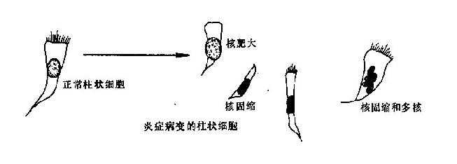 炎症病变的脱落上皮细胸形态改变示意图