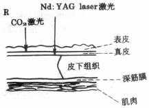 CO2激光与Nd:YAG激光对皮肤作用示意图