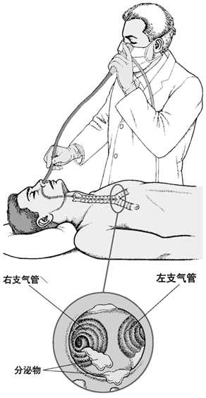 支气管镜检查