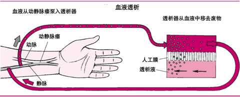 血液透析