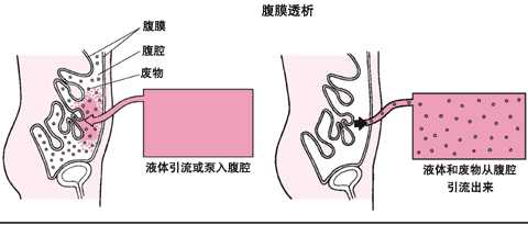 腹膜透析
