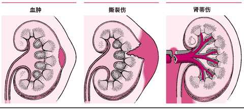 肾脏外伤