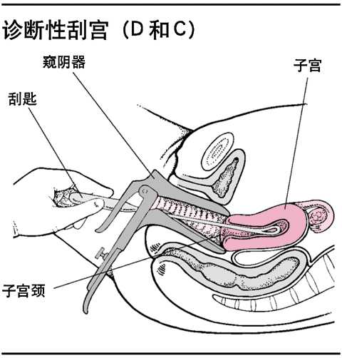 诊断性刮宫(D和C)