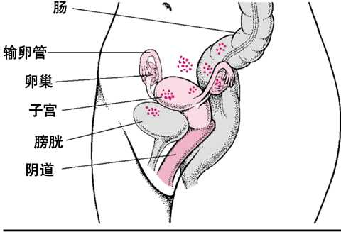 子宫内膜异位症:错位的组织