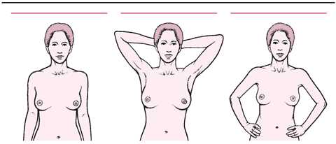 乳房自我检查