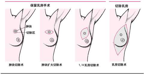 乳腺癌手术