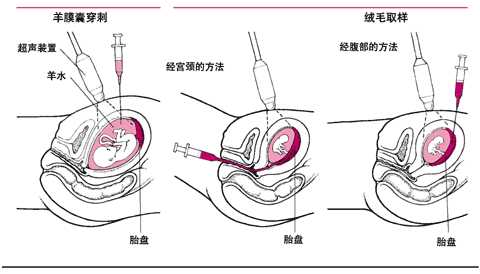 羊膜囊穿刺