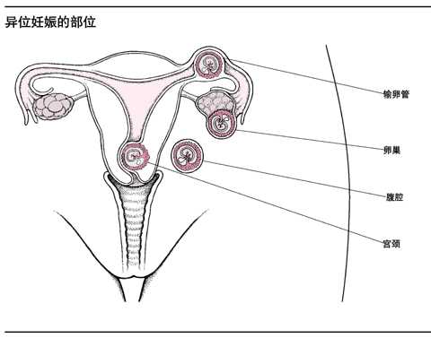 异位妊娠
