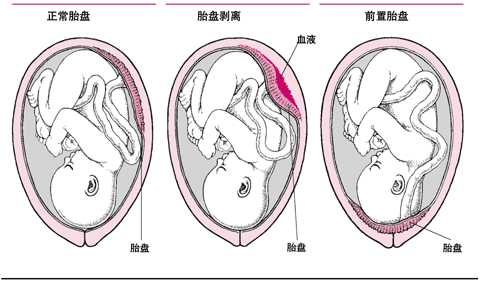胎盘异常