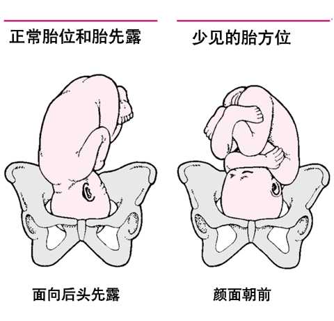胎位异常