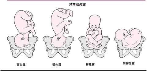 胎位异常