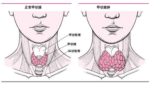 甲状腺增大