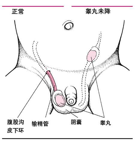 隐睾症