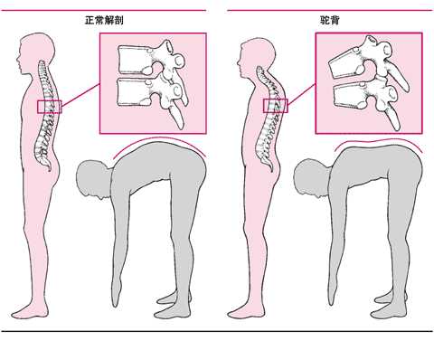 驼背