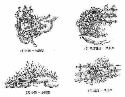 肠套迭的几种类型