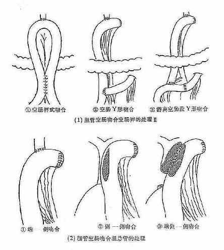 胆总管空肠多种形式吻合