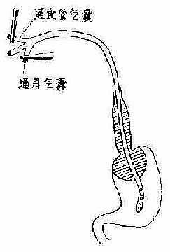 三腔管压迫止血法