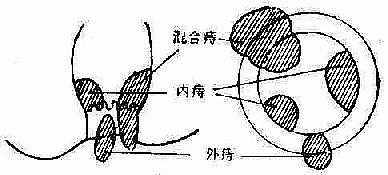 痔的类型与齿状线的关系